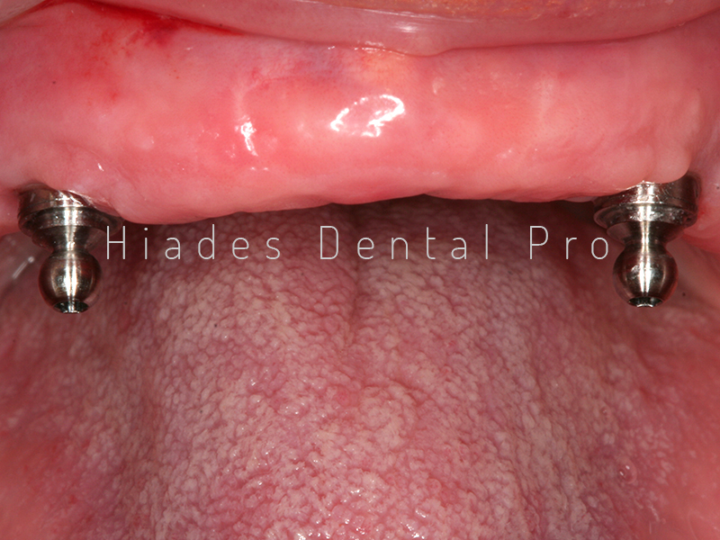 Prótesis sobre implantes Hiades Dental Pro